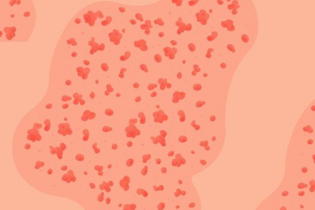 9 câu hỏi giúp “giải mã” các phát ban trên da