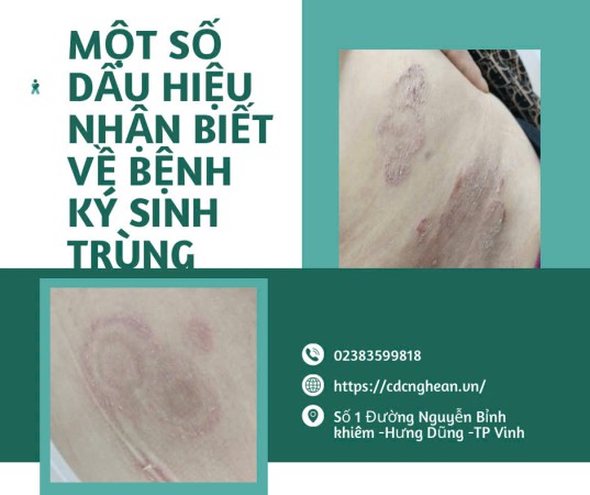 MỘT SỐ DẤU HIỆU NHẬN BIỆT VỀ BỆNH KÝ SINH TRÙNG