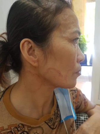 Hình ảnh ấu trùng di chuyển của bệnh nhân bị bệnh ấu trùng giun lươn