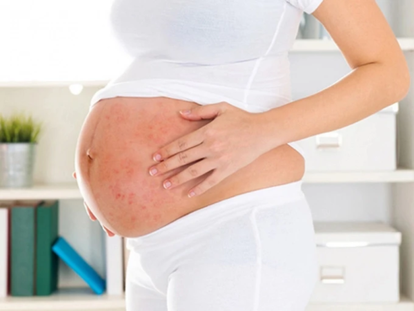 Cảnh giác với bệnh sởi ở phụ nữ mang thai