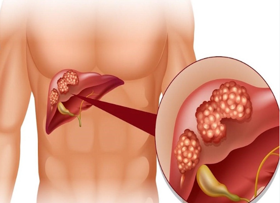 HƯỞNG ỨNG NGÀY THẾ GIỚI PHÒNG CHỐNG VIÊM GAN 28/7/2025 CHỦ ĐỘNG PHÒNG NGỪA VIÊM GAN – BẢO VỆ LÁ GAN, BẢO VỆ CUỘC SỐNG