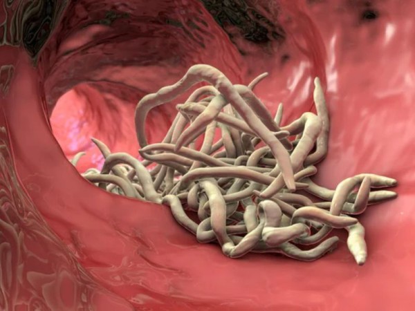 BỆNH GIUN KIM: NGUYÊN NHÂN, TRIỆU CHỨNG, CÁCH PHÒNG CHỐNG