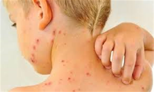 Khuyến cáo phòng chống bệnh sởi