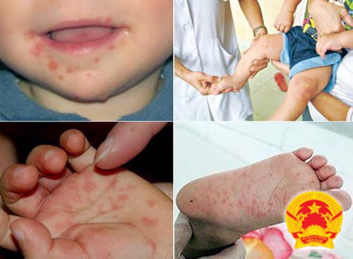 Phân biệt bệnh thuỷ đậu và bệnh tay chân miệng và cách phòng ngừa