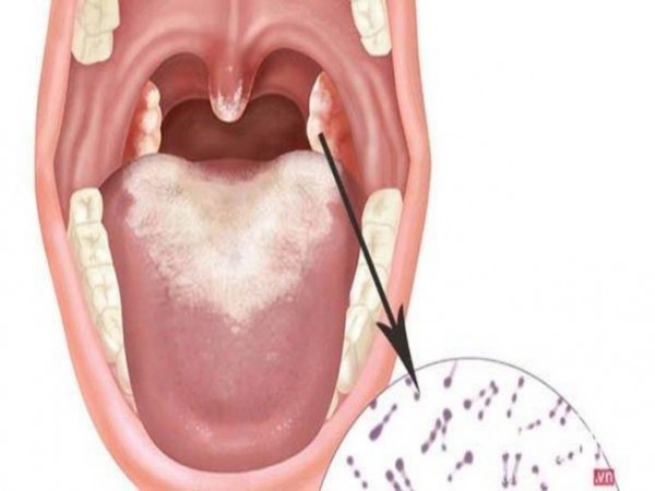 Khuyến cáo phòng chống bệnh Bạch hầu