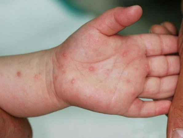 Bệnh tay chân miệng có thể gây biến chứng nguy hiểm ở trẻ
