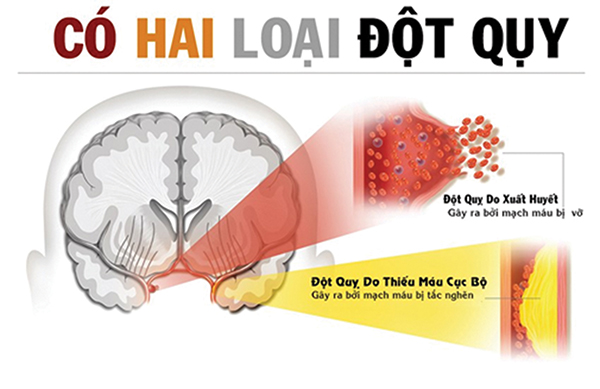CẤP CỨU ĐỘT QUỴ: SỰ SỐNG TÍNH TRONG TỪNG PHÚT GIÂY