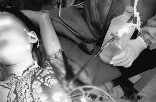 Cứu sống bé trai bị thanh sắt đâm thấu ngực