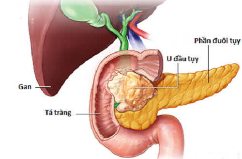 Nguyên nhân nào dẫn đến ung thư tụy?