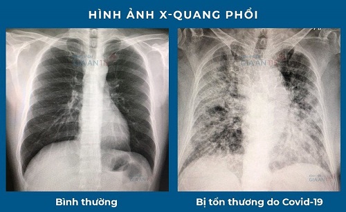Hậu COVID-19 và những điều có thể bạn chưa biết