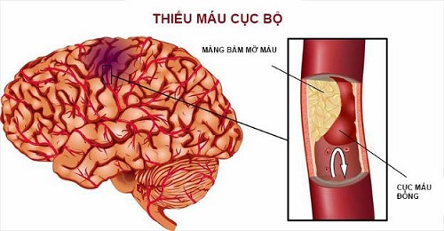 Phòng nguy cơ cục máu đông, di chứng thần kinh hậu COVID-19 bằng y học cổ truyền
