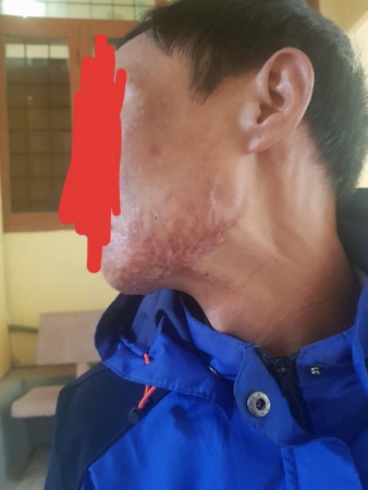 Ký sinh trùng: Nguyên nhân, triệu chứng , xét nghiệm và điều trị
