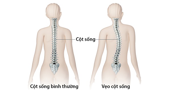 Cong vẹo cột sống ở trẻ - Nhận biết, nguyên nhân và điều trị