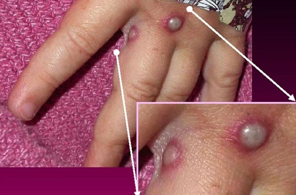 Dịch đậu mùa khỉ 'nóng' trên thế giới, Bộ Y tế yêu cầu giám sát, phát hiện ca nghi ngờ tại cửa khẩu, cơ sở y tế.