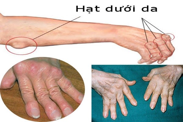 Sử dụng đúng thuốc chống viêm trong điều trị viêm khớp dạng thấp