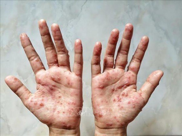 Thủ tướng: Phòng chống bệnh đậu mùa khỉ 'sớm hơn một bước, cao hơn một mức'