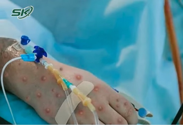 Nóng: Bệnh nhân đầu tiên mắc đậu mùa khỉ tại Việt Nam là nữ, khởi phát bệnh khi đang đi du lịch