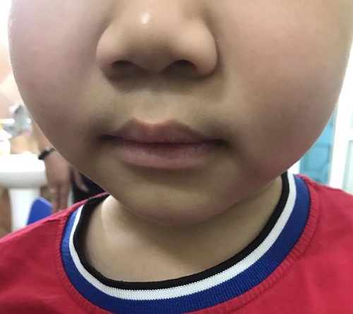 Lạm dụng thuốc xịt điều trị viêm mũi, trẻ suy tuyến thượng thận