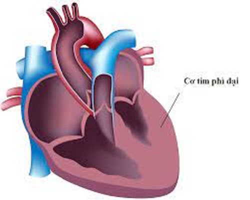 Hồi hộp, đau ngực, chóng mặt, hoa mắt… cảnh giác với bệnh cơ tim phì đại