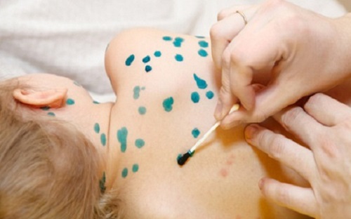 Ca mắc thuỷ đậu ở Hà Nội tăng cao, tuân thủ 5 khuyến cáo của Bộ Y tế để phòng tránh