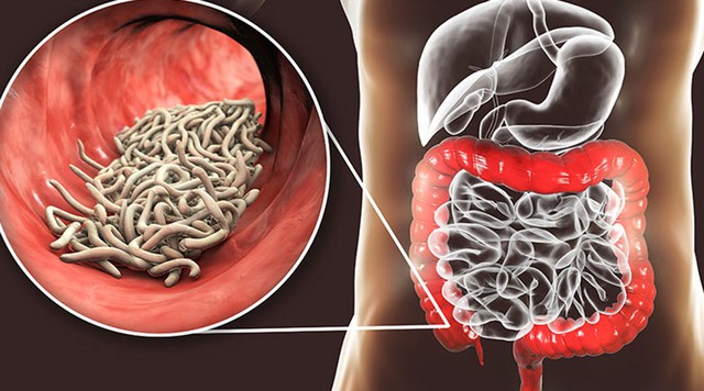 Tỷ lệ người dân nhiễm ký sinh trùng cao, Nghệ An đẩy mạnh phòng, chống