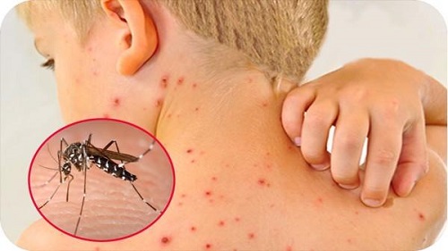 Bộ Y tế: Các tỉnh, thành tăng cường phòng chống sốt xuất huyết và dịch bệnh mùa hè