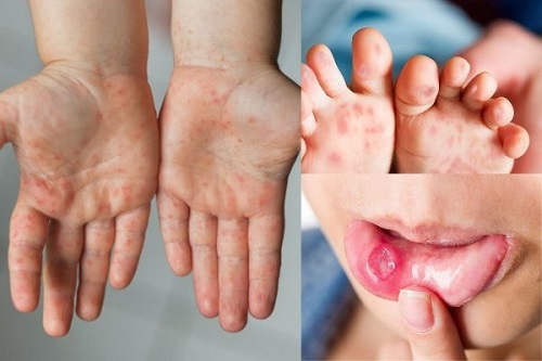 Bộ Y tế yêu cầu tăng cường theo dõi người bệnh tay chân miệng, hạn chế thấp nhất ca tử vong