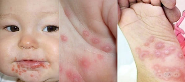 Tăng cường biện pháp phòng chống Bệnh tay chân miệng