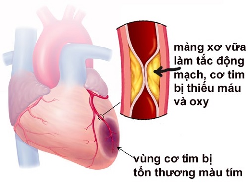 Những dấu hiệu sớm cảnh báo nhồi máu cơ tim cấp
