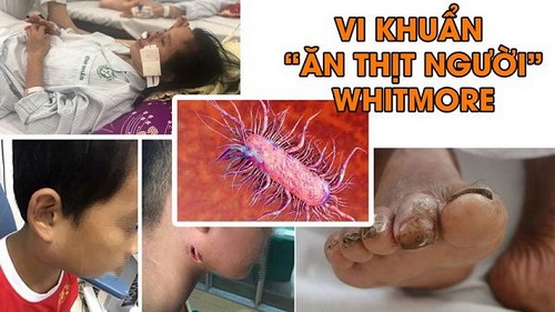 Bệnh Whitmore là gì? Biểu hiện, cách điều trị và phòng bệnh tránh tử vong