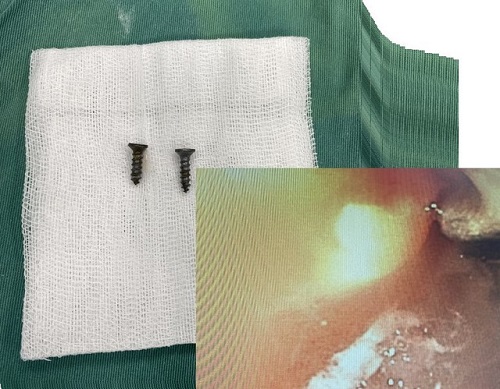 Liên tiếp cấp cứu trẻ nuốt dị vật đường tiêu hoá