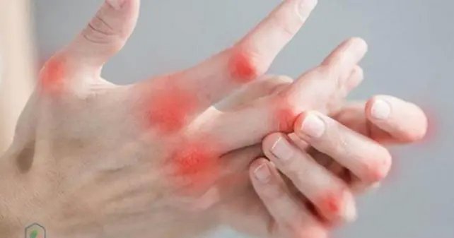 Bài thuốc đông y trị đau nhức khớp