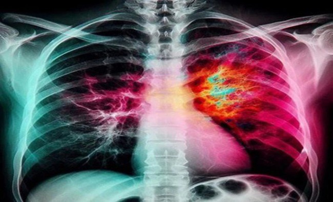 Viêm phổi: Biểu hiện, nguyên nhân, chẩn đoán và điều trị