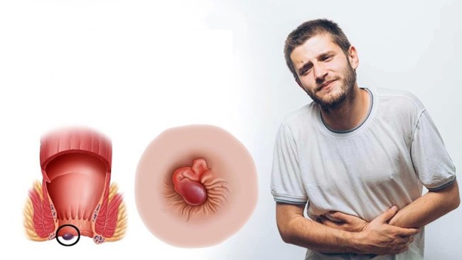 Các phương pháp điều trị bệnh trĩ