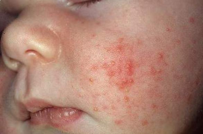 Nhiễm trùng sơ sinh có điều trị được không?