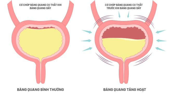 Bàng quang tăng hoạt: Nguyên nhân, triệu chứng và cách điều trị