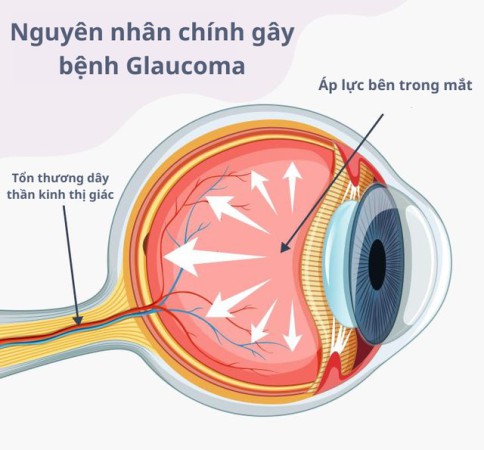 Hàng triệu người trên thế giới mù lòa vĩnh viễn vì căn bệnh Glôcôm