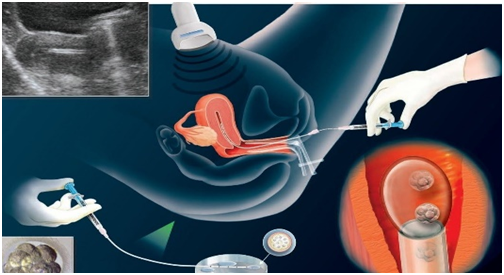 Cần làm gì để có kết quả chuyển phôi thành công