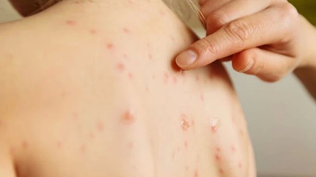 Gia tăng ca mắc sởi, hầu hết chưa tiêm vaccine, TPHCM lập tổ chuyên gia điều trị