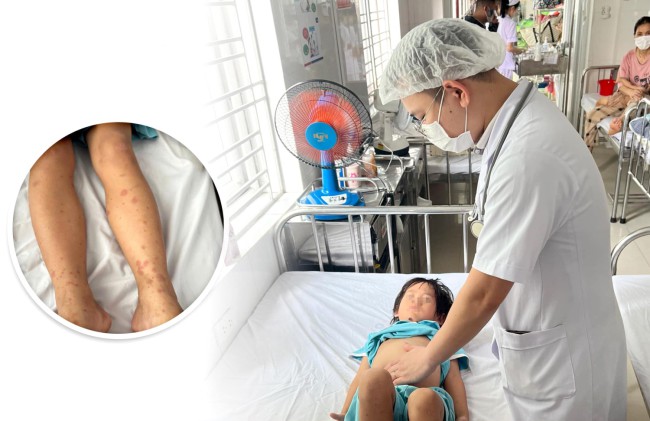 Cảnh giác với viêm mao mạch dị ứng ở trẻ từ những biểu hiện dễ bỏ qua dưới đây
