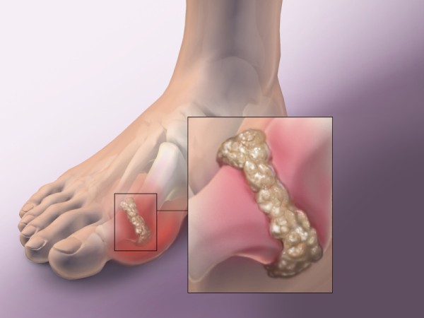 Dùng colchicin trị gout cấp tính, cẩn thận với ngộ độc thuốc