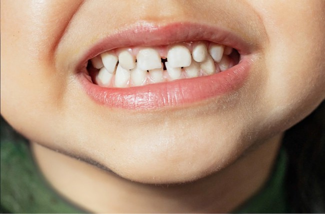 Top 3 sai lầm khi chăm sóc răng sữa ở trẻ