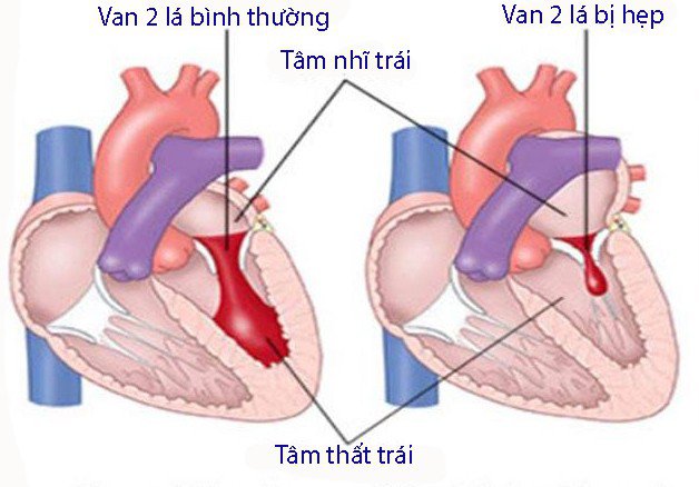 Hẹp van hai lá: Nguyên nhân, biểu hiện, cách điều trị và phòng bệnh