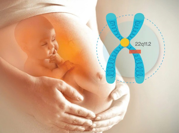 Hội chứng DiGeorge: Nguyên nhân, biểu hiện, cách điều trị và phòng bệnh