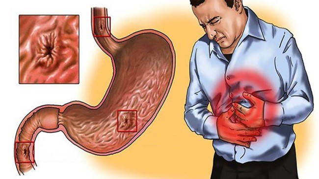 Loét dạ dày tá tràng: Nguyên nhân, biểu hiện, cách điều trị và phòng bệnh