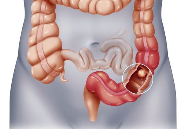Liệt ruột: Nguyên nhân, biểu hiện, cách điều trị và phòng bệnh
