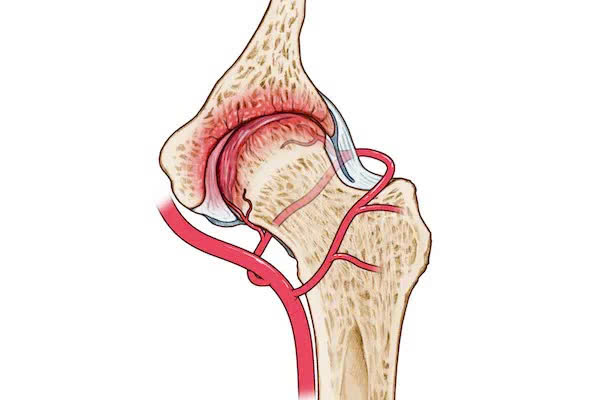 Hoại tử chỏm xương đùi: Nguyên nhân, biểu hiện, cách điều trị và phòng bệnh