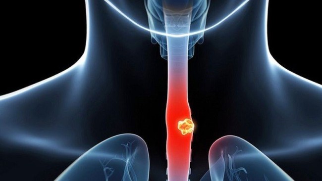 Loét thực quản: Nguyên nhân, biểu hiện, cách điều trị và phòng bệnh