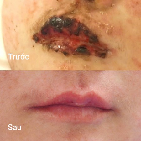 Môi tím đen như trúng độc sau một ngày tự uống thuốc cảm