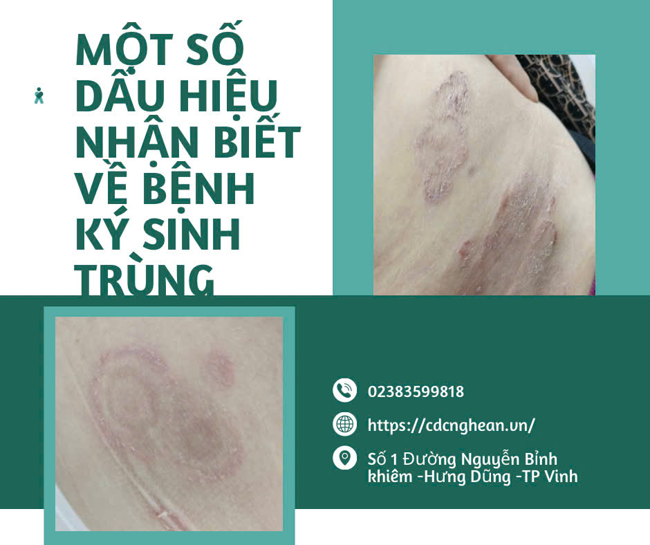 MỘT SỐ DẤU HIỆU NHẬN BIỆT VỀ BỆNH KÝ SINH TRÙNG
